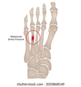 Stress Fracture Marching Fracture Foot Fracture Stock Vector (Royalty ...