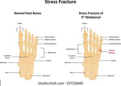 Stress Fracture Of Metatarsal