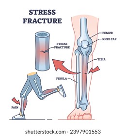 Fractura de estrés y lesión ósea esquelética después del diagrama esquemático de sobreutilización física. Esquema educativo etiquetado con doloroso estado de salud de los atletas después de la alta actividad física ilustración vectorial.