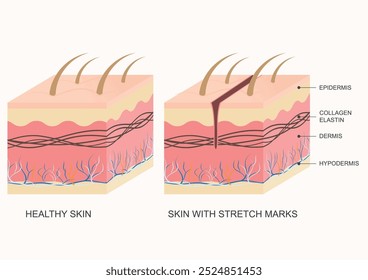 Stretch mark is a type of scar that develops when skin stretches or shrinks quickly. The abrupt change causes the collagen and elastin, which support our skin, to rupture.Medical healthcare, vector