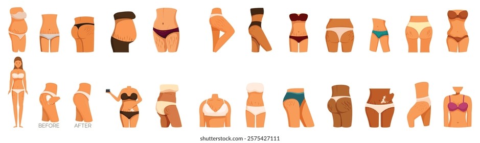  Stretch marks icons set. Female body positive and overweight problems, liposuction and cellulite removal concept