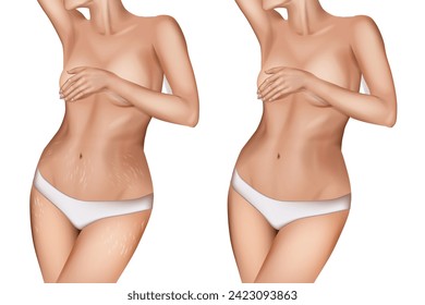 Stretch marks, also known as striae or striae distensae. Striae are caused by tearing of the dermis. Before and After 