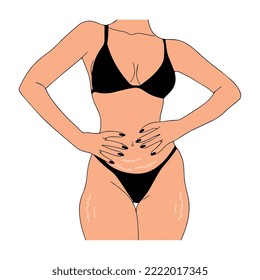 Marcas de estiramiento en el abdomen y muslos de una mujer. Ilustración vectorial.