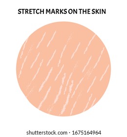 Stretch marks on the skin. Background stretch marks on the skin. Infographics. Vector illustration