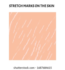 Stretch marks on the skin. Background stretch marks on the skin. Infographics. Vector illustration