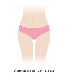 Stretch marks on tummy vector illustration isolated on white background. The white stretch marks appear on the abdomen, mid stomach, belly of woman body. Skin care and beauty concept.