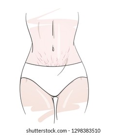 Stretch marks on woman abdomen after pregnancy. Fashion woman sketch. Skin care. Cosmetology concept. Hand drawn vector illustration. 