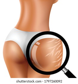 Marcas de estiramiento en las nalgas de la mujer y vidrio de aumento