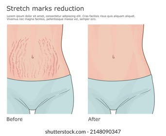 Stretch marks reduction illustration. Woman belly with and without stretch marks. Before correction and after.