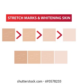 Stretch marks skin to clear steps and whitening tones vector illustration