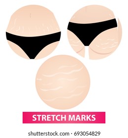 stretch marks skin vector illustration