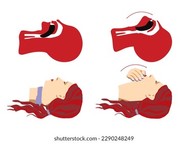 Estirar la cabeza sobre la cabeza como medida de primeros auxilios para mantener las vías respiratorias despejadas