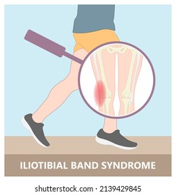 Stretching treat athlete tear sprain muscle inflammatory runner cycling hiking shot knee hip pain sport IT band Pes bursa tract medial soccer tibia femoris RICE Rest ice elevation method strain