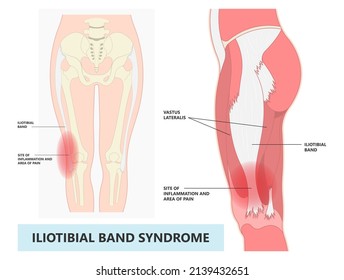 Stretching treat athlete tear sprain muscle inflammatory runner cycling hiking shot knee hip pain sport IT band Pes bursa tract medial soccer tibia femoris RICE Rest ice elevation method strain