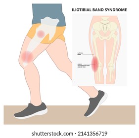 Stretching treat athlete tear sprain muscle inflammatory runner cycling hiking shot knee hip pain sport IT band Pes bursa tract medial soccer tibia femoris RICE Rest ice elevation method strain