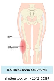 Stretching treat athlete tear sprain muscle inflammatory runner cycling hiking shot knee hip pain sport IT band Pes bursa tract medial soccer tibia femoris RICE Rest ice elevation method strain