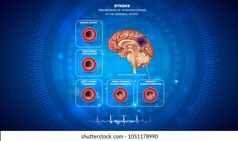 Stroke, Blood Clot Formation In The Brain Artery, Brain Damage. Abstract Blue Technology Background With Cardiogram.