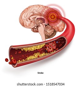 Stroke. A Blood Clot In The Vessels Of The Human Brain. Human Anatomy Disease. Acute Impairment Of Cerebral Circulation. Medical 3d Vector Illustration Isolated On White Background.