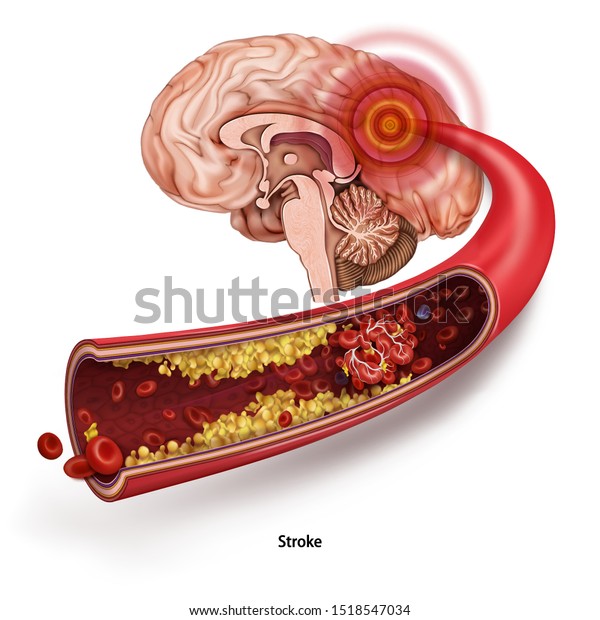 Stroke. A blood clot in the vessels of the human brain. Human anatomy Disease. Acute impairment of cerebral circulation. Medical 3d vector illustration isolated on white background.