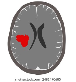 Stroke or CVA in brain (Vector)