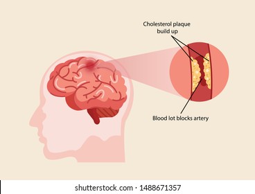 Stroke disease, atherosclerosis. Scientific medical illustration of human brain stroke illustration. illustration, vector.