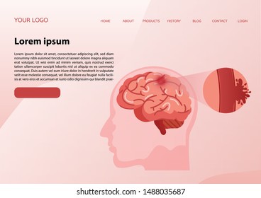 Stroke disease, hemorrhagic. Scientific medical illustration of human brain stroke illustration. illustration, vector.
