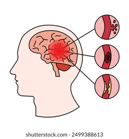 Stroke disease illustration. brain damage. head injury