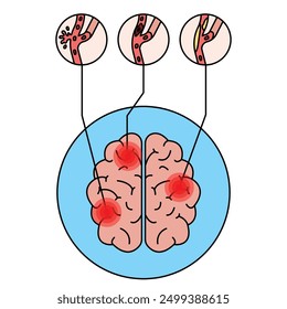 Stroke disease illustration. brain damage. head injury