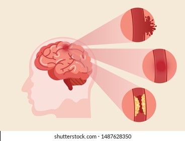 Stroke Disease, Ischemic, Atherosclerosis And Hemorrhagic. Scientific Medical Illustration Of Human Brain Stroke Illustration. Illustration, Vector.