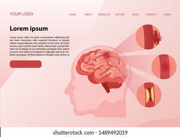 脳卒中 虚血性 アテローム性動脈硬化 出血性 人間の脳卒中のイラストを科学的に示したイラスト イラスト ベクター画像 のベクター画像素材 ロイヤリティフリー