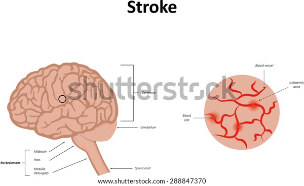 Stroke Illustration Stock Vector (Royalty Free) 288847370 | Shutterstock