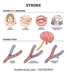 Stroke Medical Condition With Fast Response And Types Outline Diagram. Labeled Educational Scheme With Brain Blood Supply Problem And Ischemic, Transient Or Hemorrhagic Examples Vector Illustration.