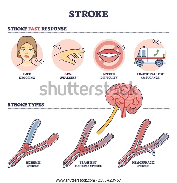 Stroke medical condition with fast response\
and types outline diagram. Labeled educational scheme with brain\
blood supply problem and ischemic, transient or hemorrhagic\
examples vector\
illustration.