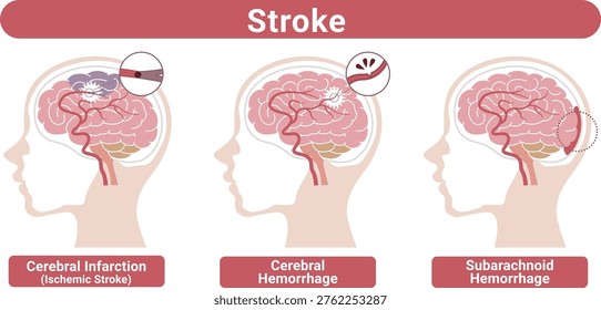 Stroke types brain infarction cerebral hemorrhage subarachnoid hemorrhage medical illustration(English Labels)