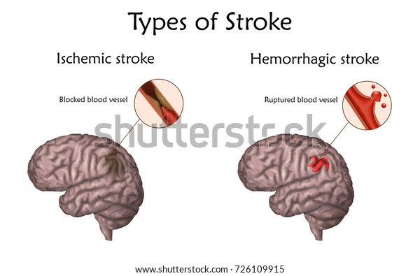 Stroke Types Poster Banner Hemorrhagic Ischemic Stock Vector Royalty