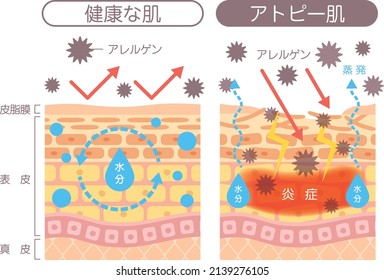 Structural diagram of the skin
Atopic dermatitis

Described in Japanese as "healthy skin," "atopic skin," "allergen," "moisture," and "inflammation."