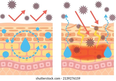 Structural diagram of the skin
Atopic dermatitis