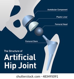 Structure Of The Artificial Hip Joint, Vector Illustration