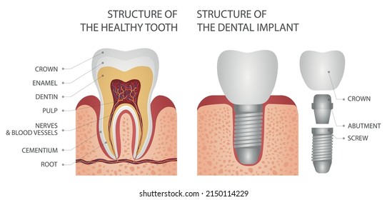 Structure of the dental implant. Medical vector illustration.