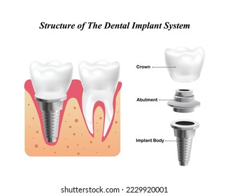 Structure of The Dental Implant System - tooth implant procedure