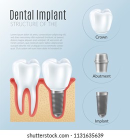 Structure of dental prosthetics infographics poster with denture near healthy tooth crown abutment implant realistic icons vector illustration