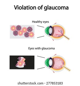 The structure of the eye. Blurred vision in glaucoma. As the eye can see the affected with glaucoma.