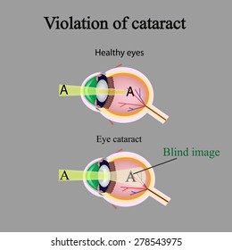 The structure of the eye. Cataracts. As the affected eye sees cataracts. Violation of cataract.