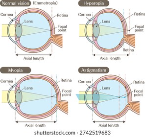 Structure of the Eye and Refractive Errors Diagram