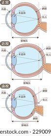 Structure of the eye_Visual acuity

It is written in Japanese as "normal", "myopia", "hyperopia", "cornea", "lens", and "retina".