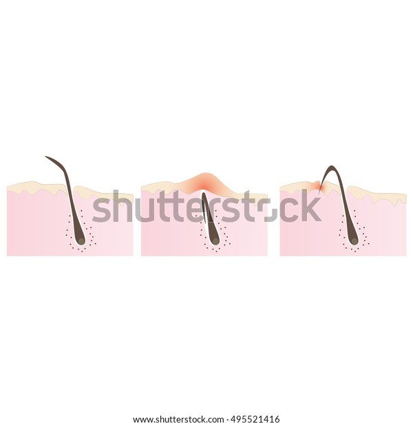 Structure Hair Follicle Ingrown Hairs When Stock Vector Royalty