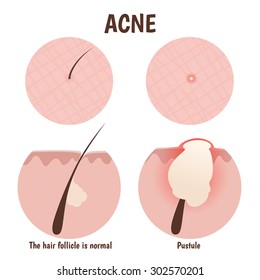 structure of the hair follicle, problem skin with pustules, pimples