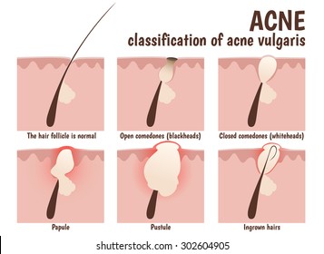 structure of the hair follicle, problem skin with pustules, acne, open comedones blackheads and closed comedones whiteheads