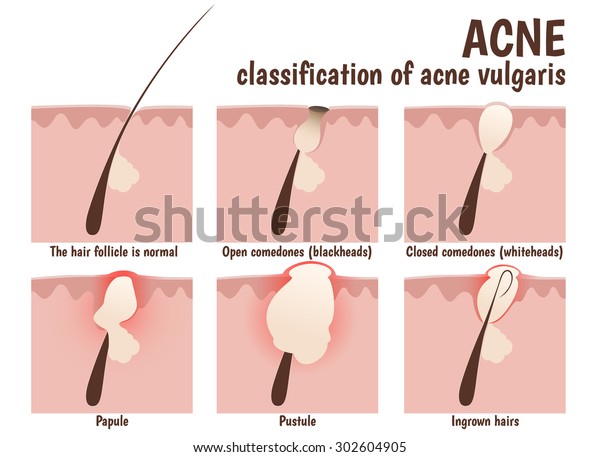 Structure Hair Follicle Problem Skin Pustules Stock Vector