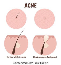 structure of the hair follicle, problematic skin with whiteheads